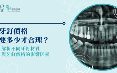 牙釘價格要多少才合理?解析不同牙釘材質與牙釘價格的影響因素