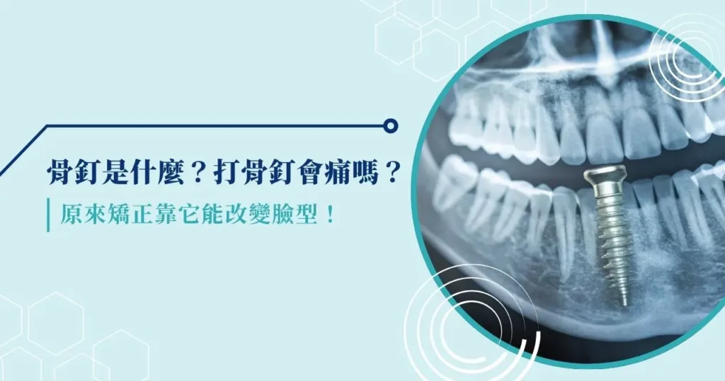 骨釘是什麼?打骨釘會痛嗎?原來矯正靠它能改變臉型!