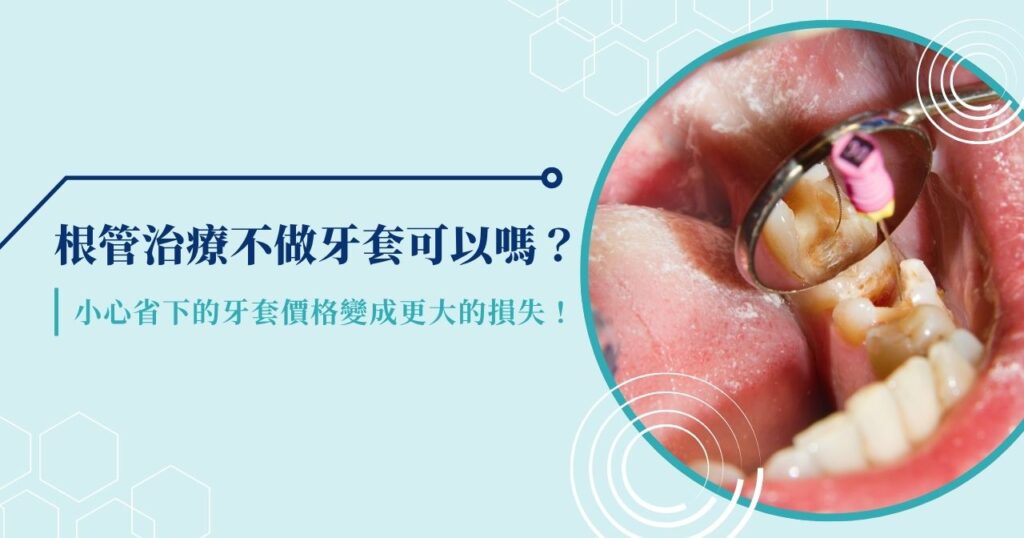 根管治療不做牙套可以嗎?小心省下的牙套價格變成更大的損失!