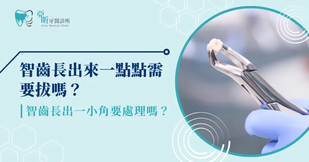 智齒長出來一點點需要拔嗎?智齒長出一小角要處理嗎?
