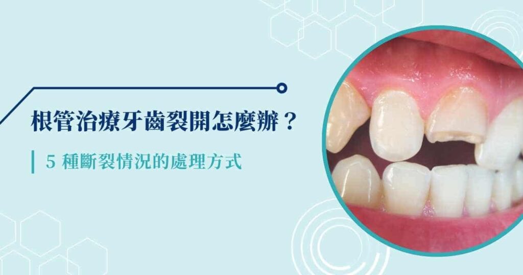 根管治療牙齒裂開怎麼辦? 5 種斷裂情況的處理方式