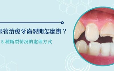 根管治療牙齒裂開怎麼辦? 5 種斷裂情況的處理方式