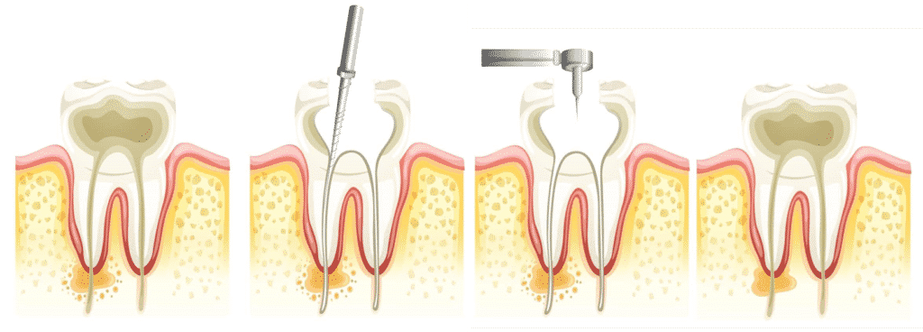 泰山最專業牙醫-亞昕牙醫-根管治療大致流程示意圖