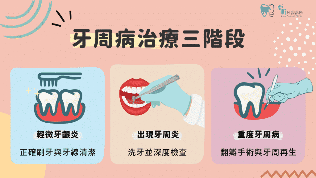牙周病治療會依照嚴重程度分為三階段進行治療