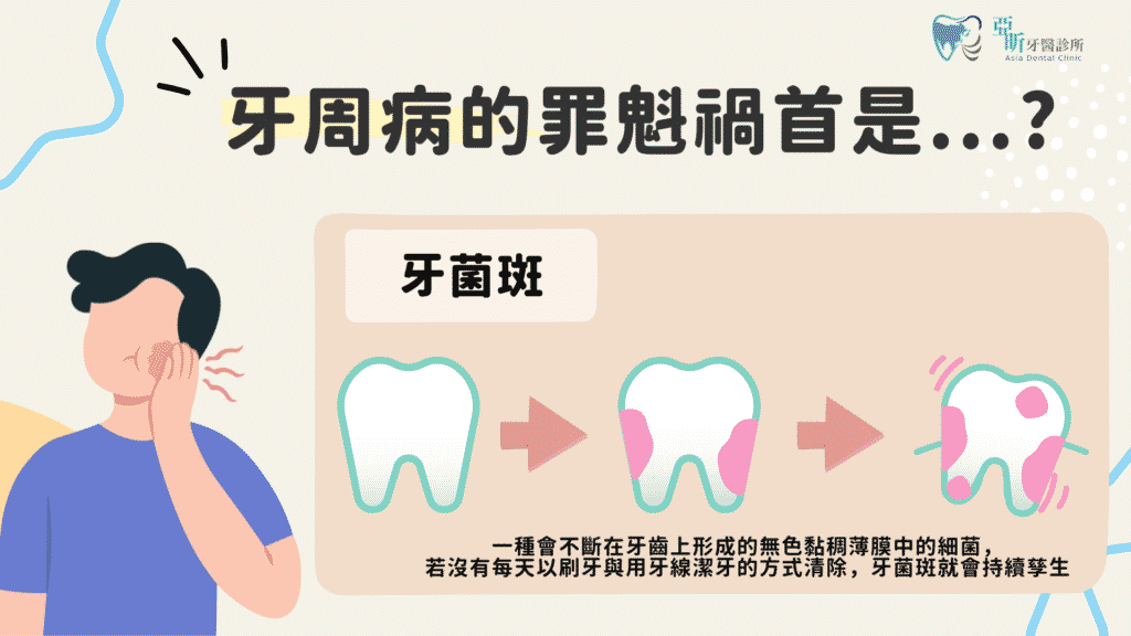 牙周病的成因為牙菌斑，若牙菌斑持續孳生則會需要到牙醫診所進行牙周病治療療程