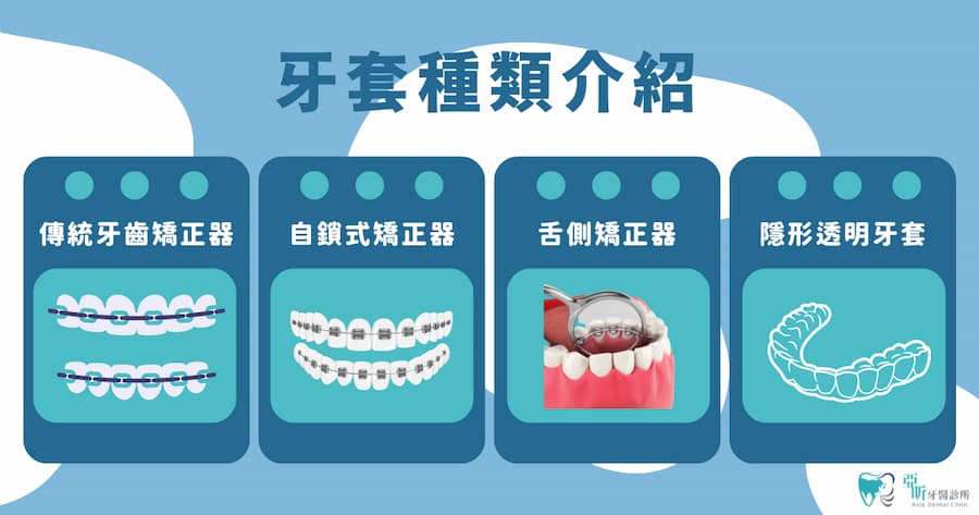 牙套種類有哪些