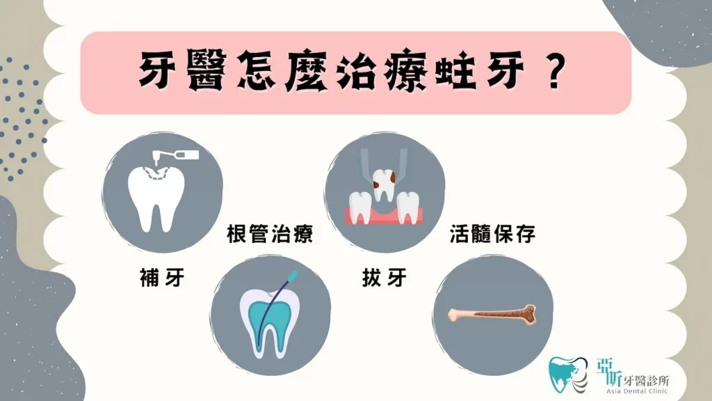 牙醫怎麼治療蛀牙? 1.補牙 2.根管治療 3.拔牙 4.活髓保存