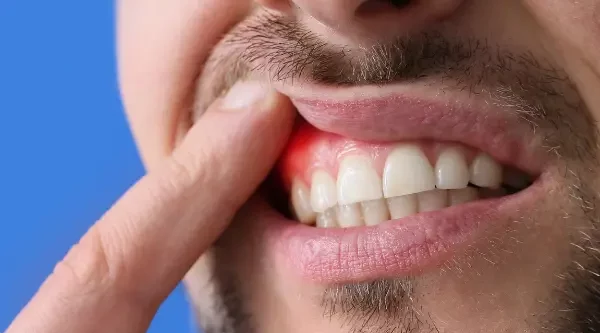 植牙失敗如何補救 植體周圍紅腫發炎示意圖