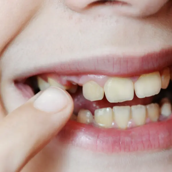 植牙失敗如何補救 牙齒或植體明顯搖晃示意圖