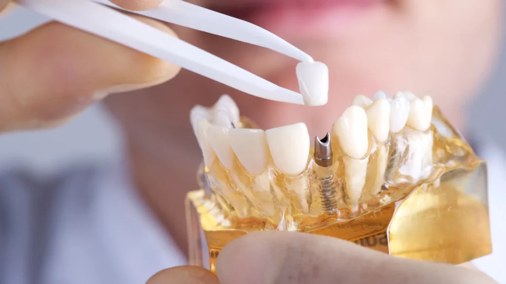 6 個步驟告訴你植牙過程如何進行