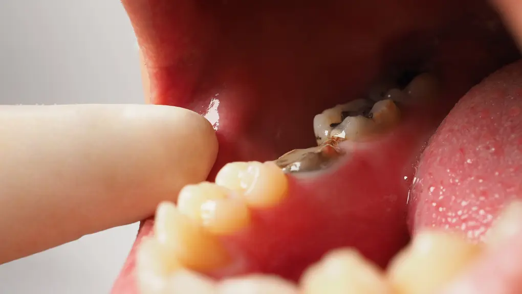 牙齒靠近牙齦黑黑的東西是蛀牙嗎？