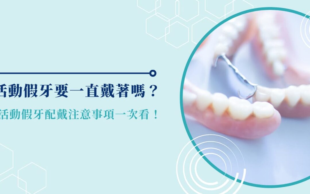 活動假牙要一直戴著嗎？活動假牙配戴注意事項一次看！