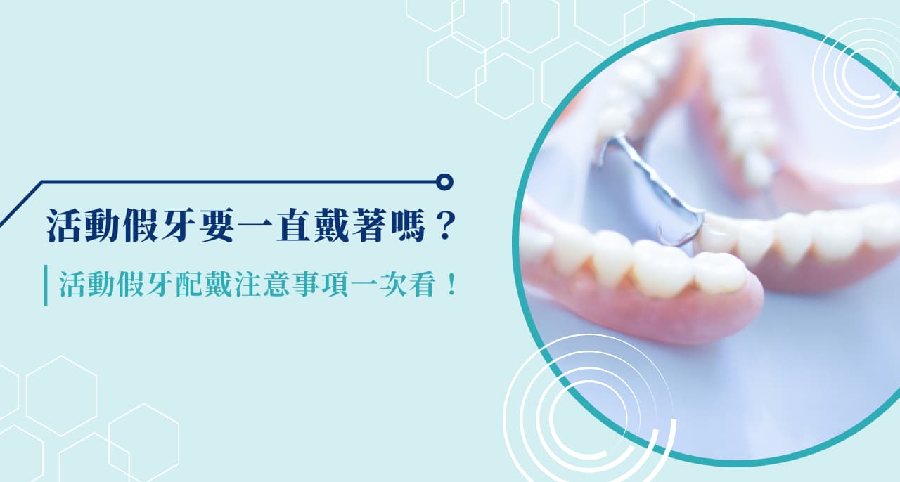 活動假牙要一直戴著嗎？活動假牙配戴注意事項一次看！