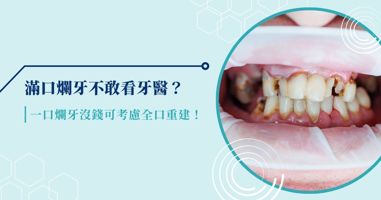 滿口爛牙不敢看牙醫？一口爛牙沒錢可考慮全口重建！