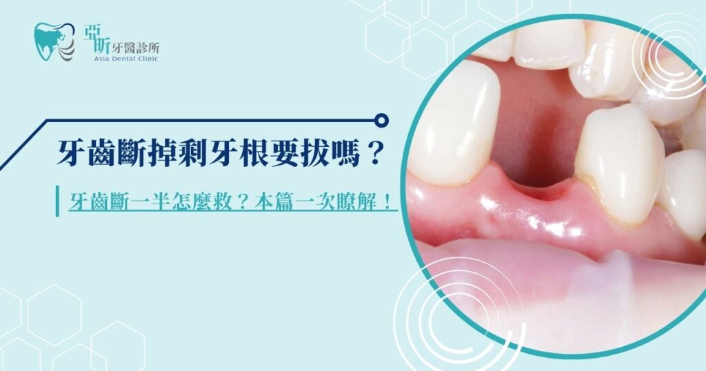 牙齒斷掉剩牙根要拔嗎？牙齒斷一半怎麼救？本篇一次瞭解！