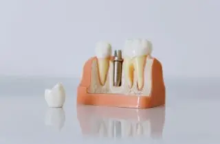 牙冠斷裂